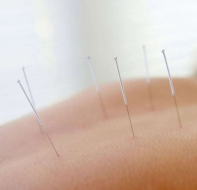 Acupuncture Medical Billing Services